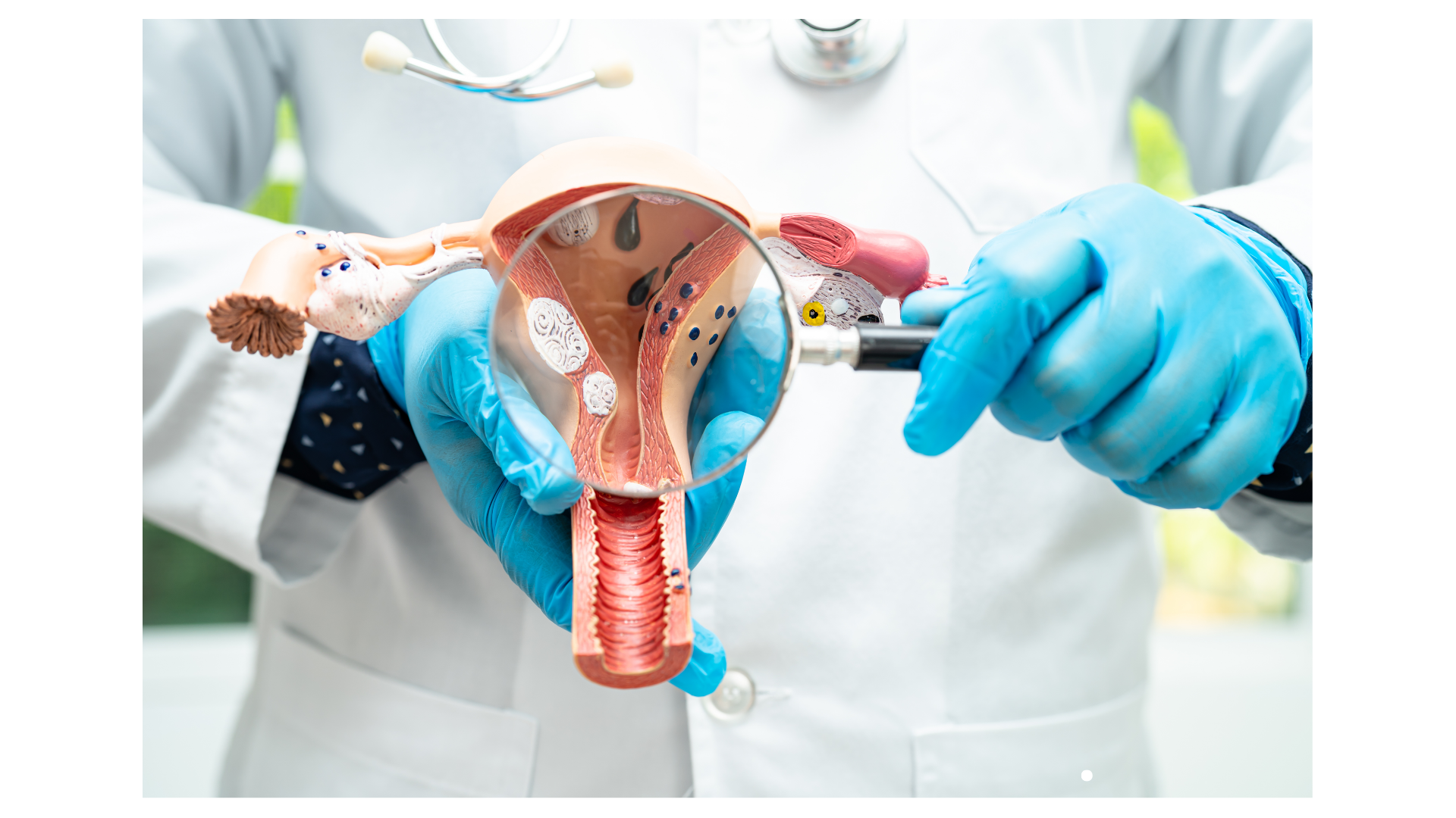 Uterine fibroids